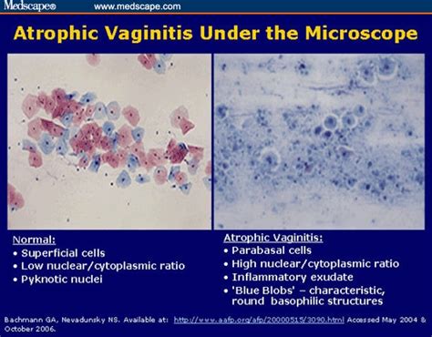 Atrophic Vaginitis And Estrogen Treatment