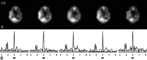 Combination Of Sense And Multiple Spin Echo Mrsi With Etl At T