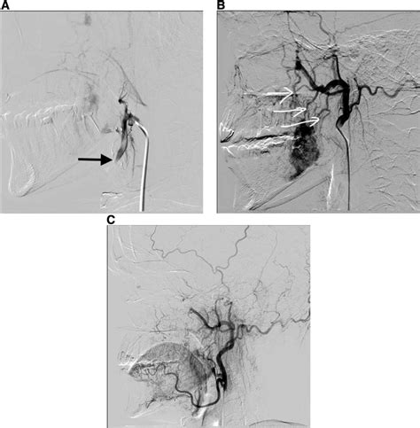 Angiographic Result After The First Embolization A Total Occlusion Download Scientific