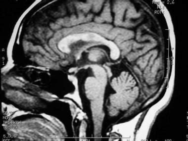 Ms Brain Mri With Contrast