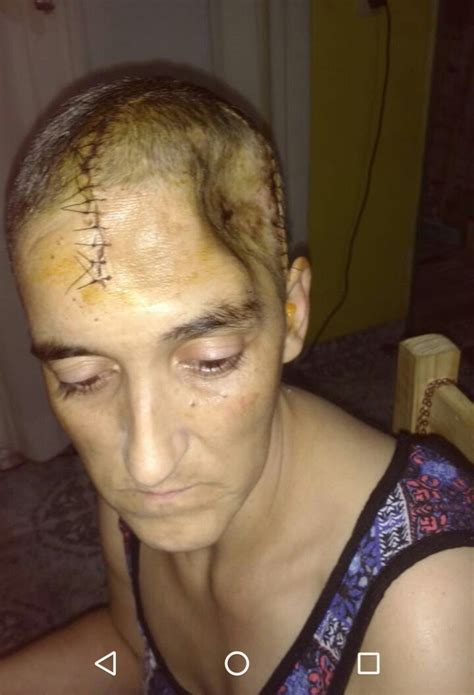 Mujer presenta dolor de muelas y debieron extirparle parte del cráneo