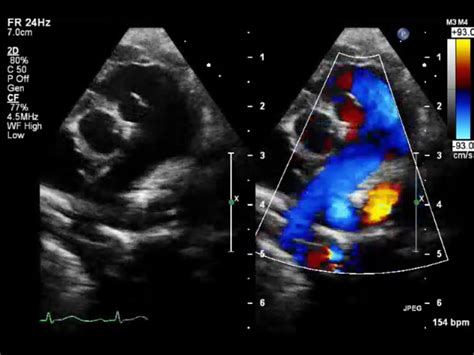 Normal Echocardiogram