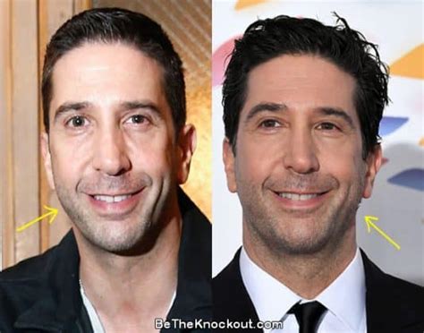 David Schwimmer Plastic Surgery Comparison Photos