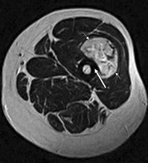 Axial T2 Weighted Magnetic Resonance Mr Image Showing A Deep Mass