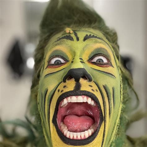 Andrew - 3. 5th metatarsal is broken, “the dancer’s fracture” - I can