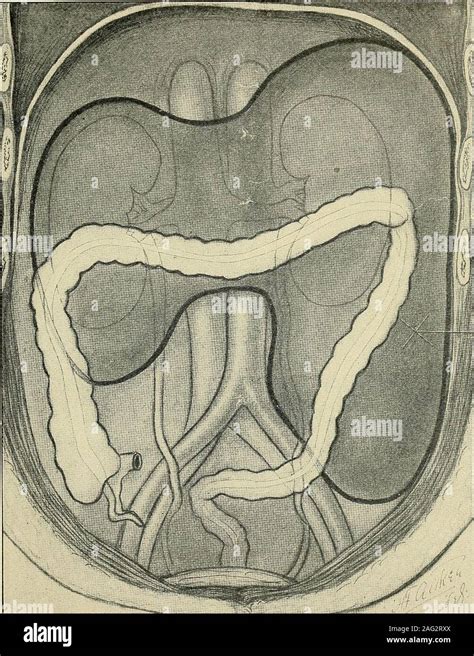 Enlarged spleen hi-res stock photography and images - Alamy