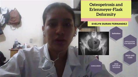 Osteopetrosis and Erlenmeyer-Flask Deformity by Evelyn Estela Duran Fernandez on Prezi Video