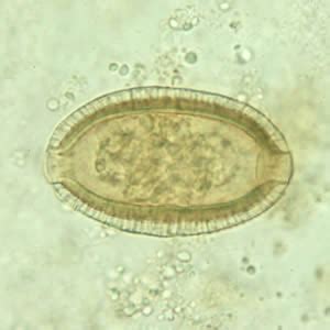 intestinal capillariasis wikidoc