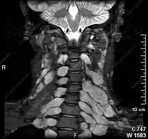 Neurofibromatosis Type Mri