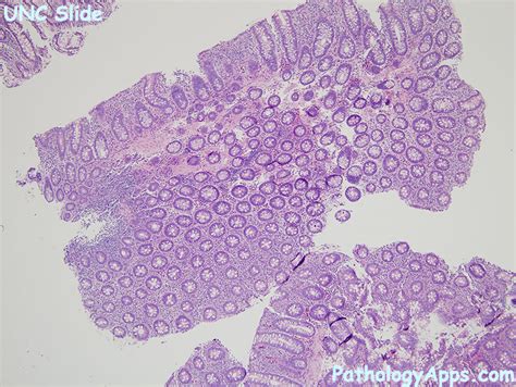 lymphocytic colitis pathology