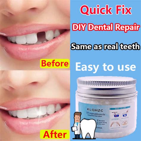 【fast Filling】diy Tooth Repair Kit Temporary Tooth Repair Kit 50g