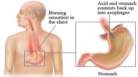 How Acid Reflux Works Animation Gastroesophageal Reflux Disease