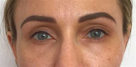 Los Angeles Non Surgical Eye Lift Santa Monica Eyelid Lift