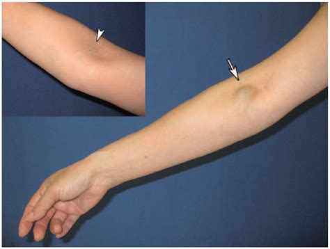 Physical Examination Of A Soft Mass On The Right Arm Of A 58 Year Old