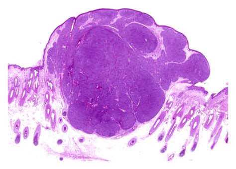 A Well Circumscribed Smooth Bordered And Deeply Basophilic Tumor In