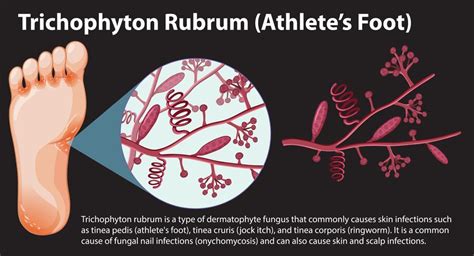 premium vector trichophyton rubrum fungal infection