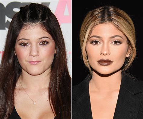 Kylie Jenners Lip Fillers — Log Lasting Filler Approved Juvederm