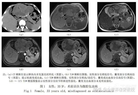 干货 胰腺实性假乳头状瘤的CT及MRI影像学表现分析 知乎