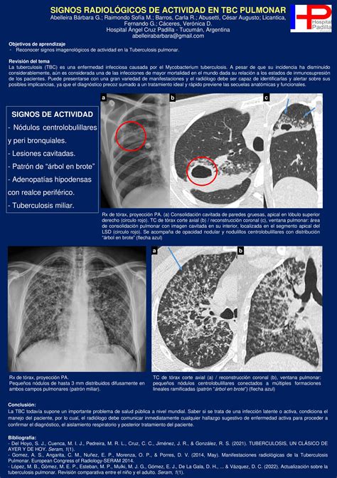 Signos Radiol Gicos De Actividad En Tbc Pulmonar Sociedad Tucumana De