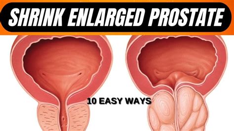 SHRINK ENLARGED PROSTATE - 10 EASY WAYS - YouTube