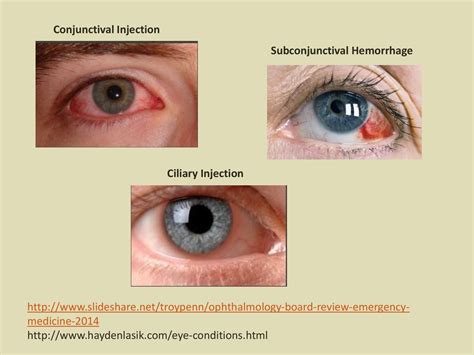 Ciliary Injection