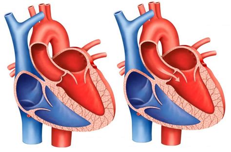 Aortic Stenosis: What you Need to Know: Premier Cardiology Consultants ...