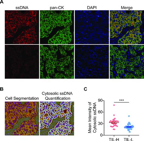 Cytosolic SsDNA Level In Tumors Is Positively Correlated With TIL Level