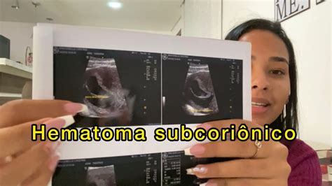 Hematoma Subcori Nico Tudo Sobre O Probleminha Do Meu In Cio De