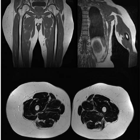 Posterior View Of The Patient Presenting With Multiple Symmetric