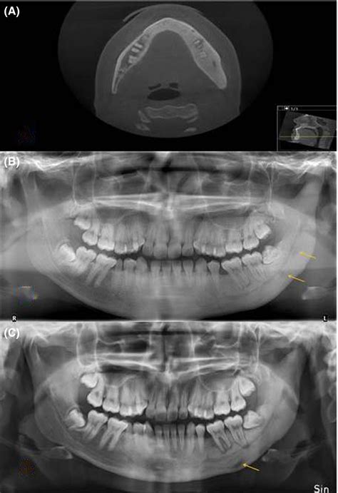 Treatment Of Diffuse Sclerosing Osteomyelitis Of The Jaw With Denosumab Shows Remarkable Results