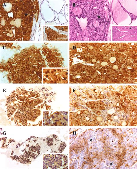 Immunolocalization Of Galectin 3 In Minimally Invasive Follicular