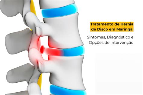 Tratamento De H Rnia De Disco Em Maring Sintomas Diagn Stico E