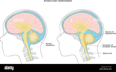 Brain Malformation In Child Arnold Chiari Malformation Stock Vector