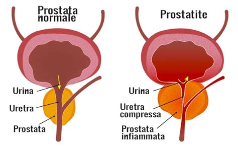 Masturbazione E Prostatite Cause Ed Effetti Prostatite24