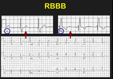 Carolinas EKG Blog - CMC COMPENDIUM