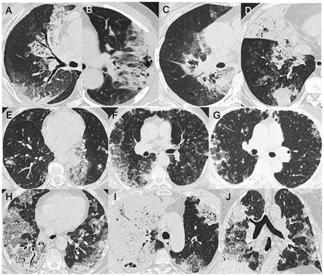 Comparative Study Of Imaging And Pathological Evaluation Of Pneumonic