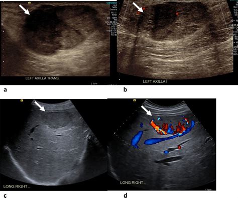 Subcutaneous Hemangioma Ultrasound