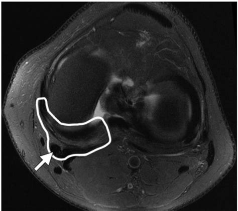 Posteromedial Corner Injury Knee Sports Orthobullets