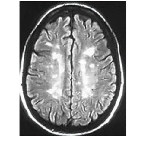 How To Deal With Multiple Sclerosis | HubPages