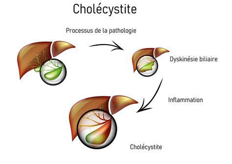 Chronic Or Acute Cholecystitis What Are The Signs