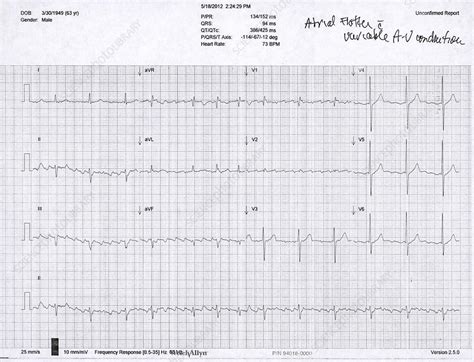 Atrial Flutter Ecg Stock Image C0221182 Science Photo Library