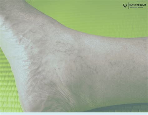 Prevent and Manage Varicose Veins around Ankles