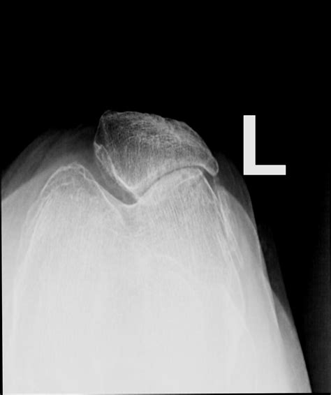 Baker Cyst With Synovial Chondromatosis Image Radiopaedia Org