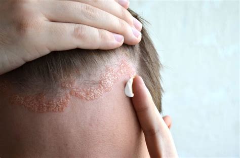 Dermatitis Seborreica Med Enfermer A