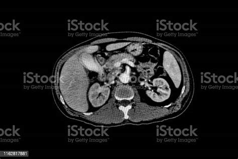 Computer Tomography Angiography Cta Of Whole Body Scan With 3d Reconstruction Ct Angiography For