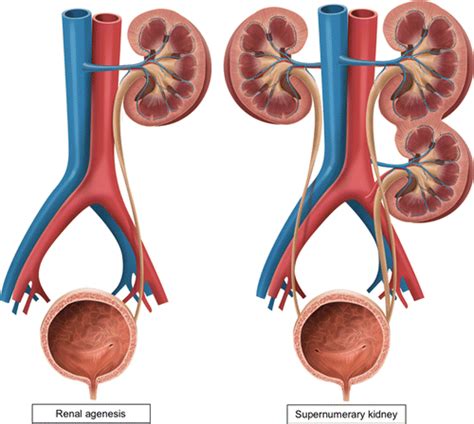 Congenital Anomalies Of The Upper Urinary Tract A Comprehensive Review