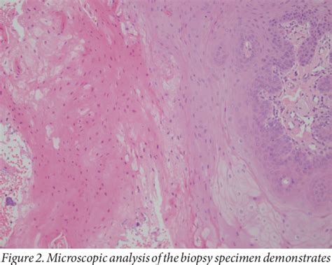 Figure 2 From Oral Hairy Leukoplakia In An HIV Negative Patient