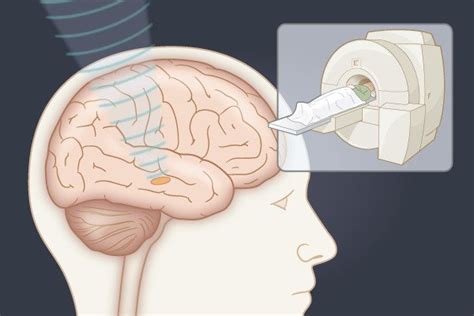 Randomized Trial Of Focused Ultrasound Subthalamotomy For Parkinson