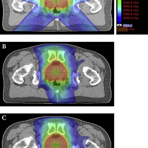 Example Of Dose Distribution Achieved Using A Intensitymodulated