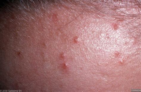 Pityriasis Folliculitis